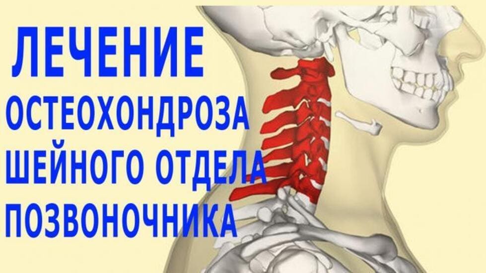 лікування остеохондрозу шийного відділу